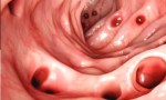 DIVERTÍCULOS EN EL COLON