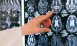 El impacto del COVID en el cerebro: detectan atrofia leve y cambios estructurales después de la infección.