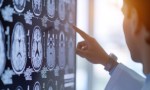 Cómo la falta de sueño afecta al cerebro.